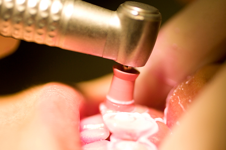 PMTC(プロの手による歯のクリーニング)