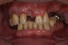 歯周病症例1（BEFORE）