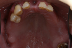 歯周病症例1（BEFORE）