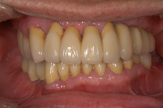 歯周病症例1（AFTER）