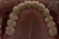 歯周病症例1（AFTER）